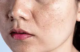 When will I see the results? Understanding healing, scabbing, scar prevention, and pigmentation changes Emsworth